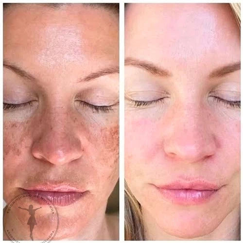 Serum 24K - Clareador Removedor de Manchas